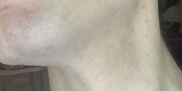 Facial Laser Hair Removal Session Three. An hour after the Laser, by Transgender Artist Sophie Lawson