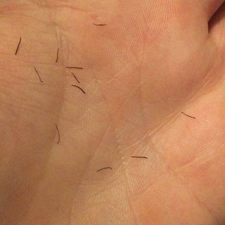 FACIAL LASER HAIR REMOVAL SESSION 3 • MY DIARY ENTRY 44