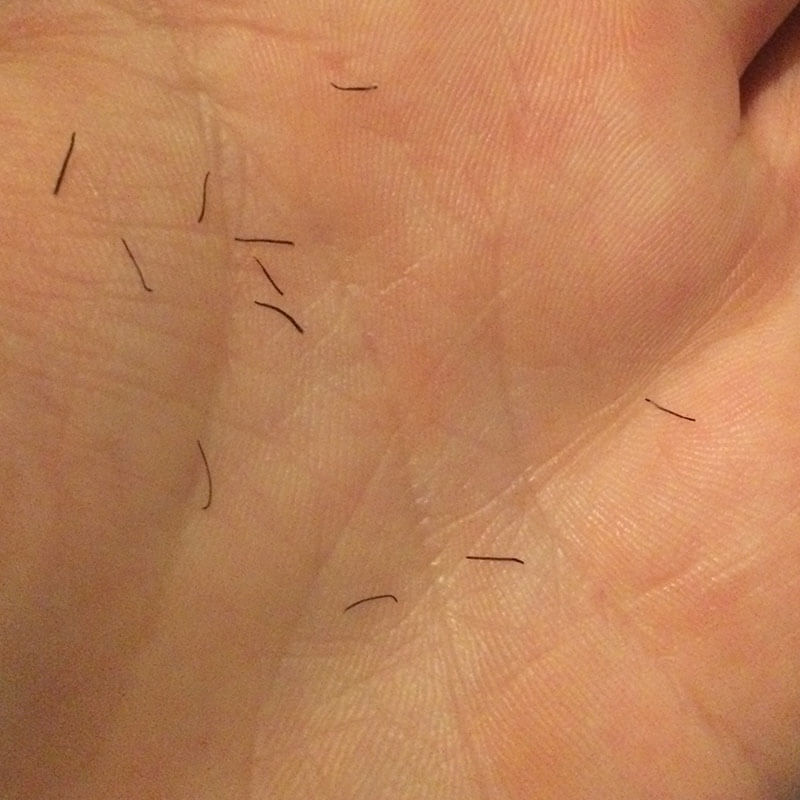 Facial Laser Hair Removal Session Three. Hairs falling out within two weeks, by Transgender Artist Sophie Lawson