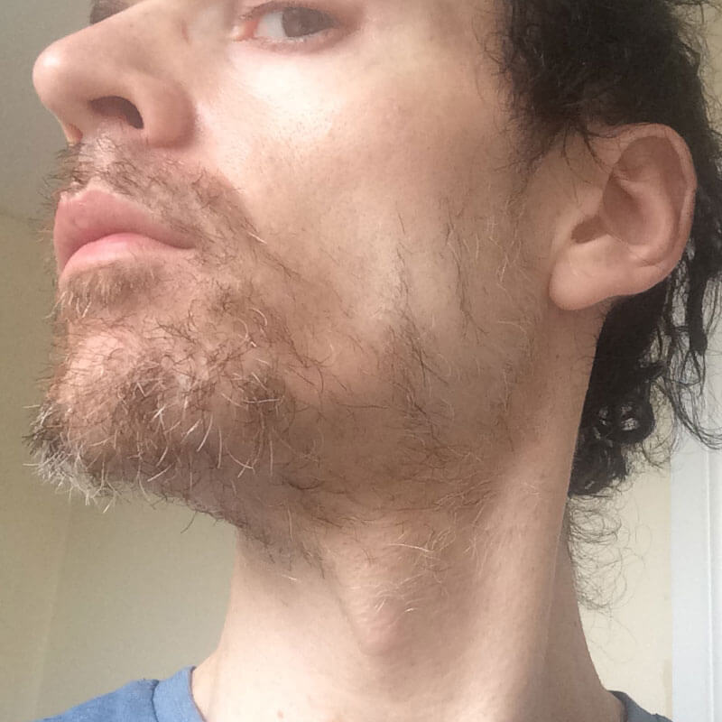 Facial Laser Hair Removal Session Three. Four weeks of growth comparison, by Transgender Artist Sophie Lawson