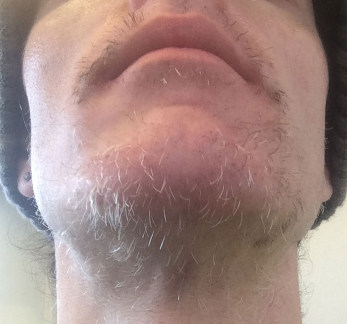 Facial Laser Hair Removal Session Five. Three weeks of growth comparison, by Transgender Artist Sophie Lawson