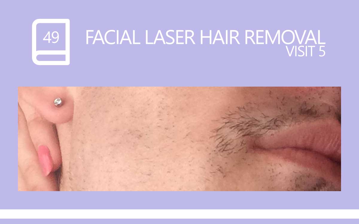 FACIAL LASER HAIR REMOVAL SESSION 5 MY DIARY ENTRY 49