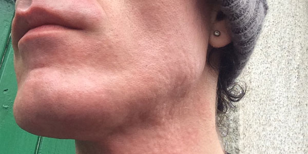 Facial Laser Hair Removal Session SIX. Minutes after the Laser, by Transgender Artist Sophie Lawson